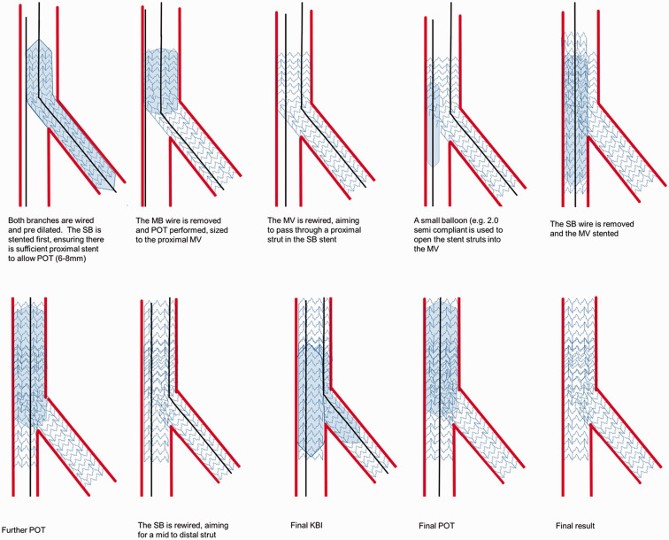 DK crush technique illustration