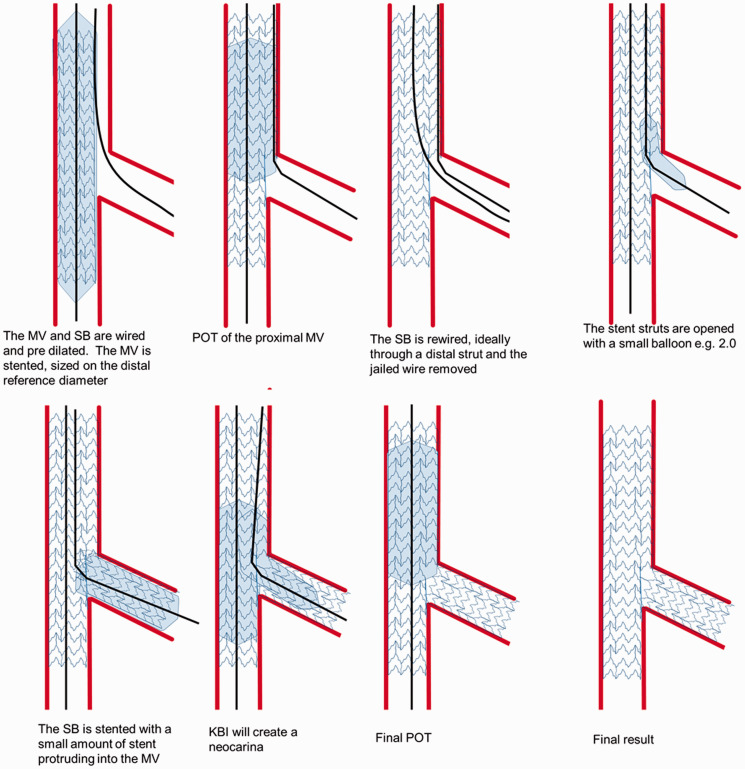 Bifurcation stenting decision algorithm