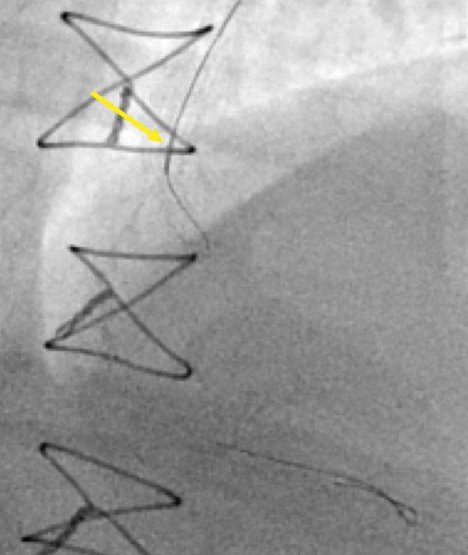 Rewiring SB technique