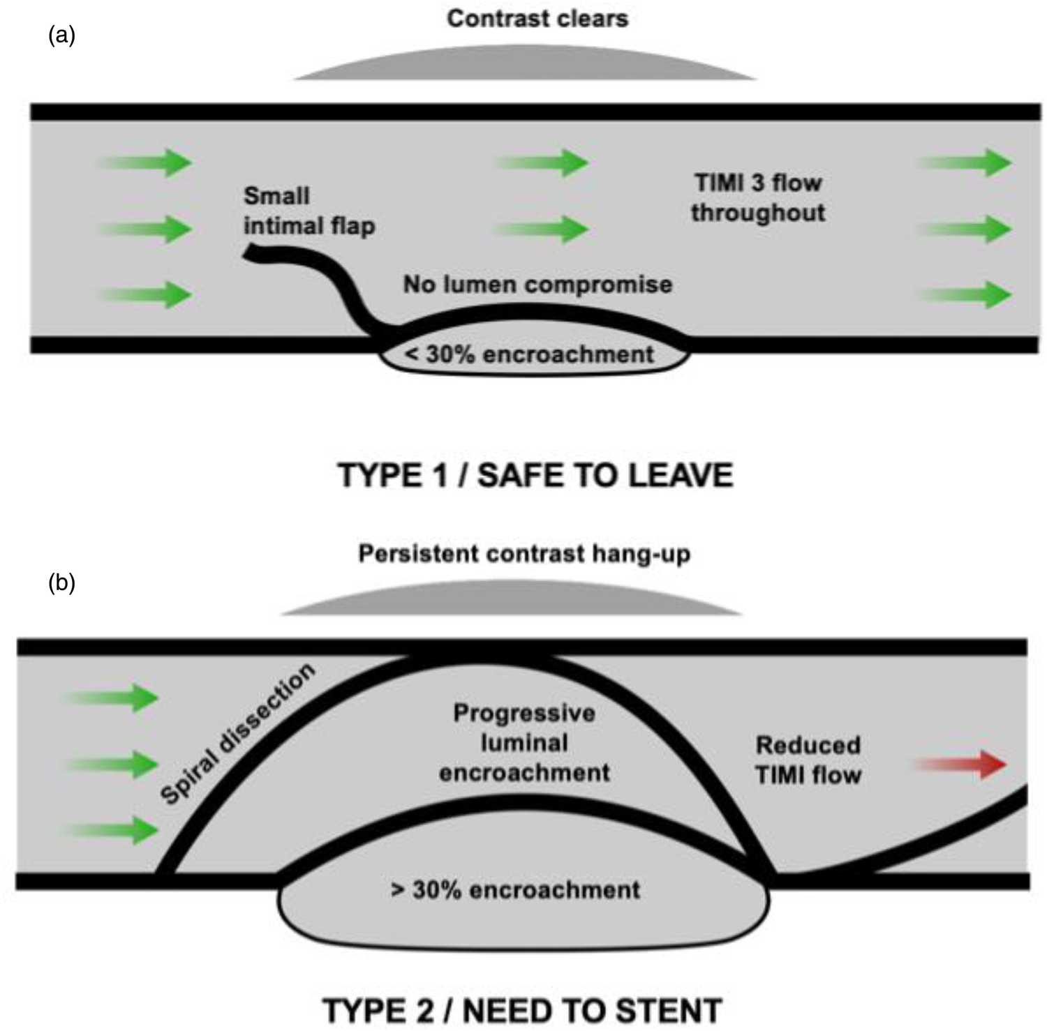 Corballis 2025 Simplified Dissection Classification